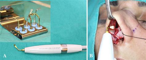 paizuri technique|Piezosurgery: basics and possibilities .
